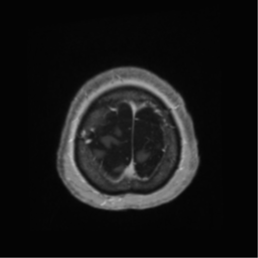Anaplastic astrocytoma IDH wild-type (pseudoprogression) (Radiopaedia 42209-45278 Axial T1 C+ 141).png
