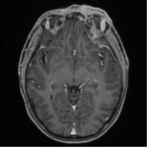 Anaplastic oligodendroglioma with skull fracture (Radiopaedia 74831-85845 Axial T1 C+ fat sat 27).png