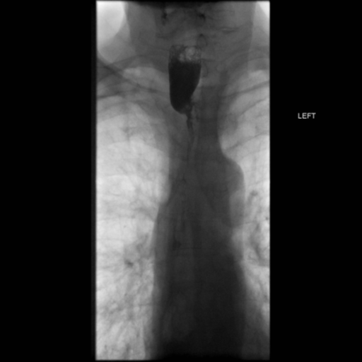 File:Anastomotic stricture post Ivor Lewis esophagectomy (Radiopaedia 47937-52715 B 14).png