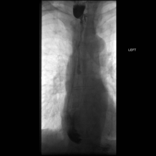 File:Anastomotic stricture post Ivor Lewis esophagectomy (Radiopaedia 47937-52715 B 33).png