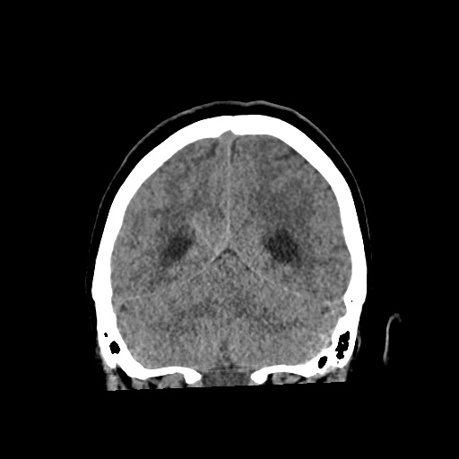Aneursym related subarachnoid hemorrhage with hydrocephalus (Radiopaedia 45105-49083 Coronal non-contrast 50).jpg
