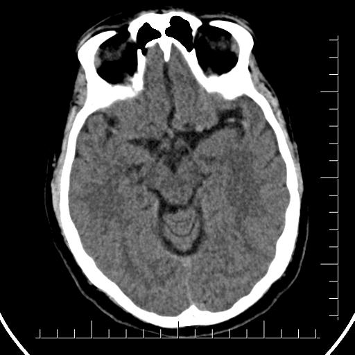 File:Aneurysm of posterior communicating artery (Radiopaedia 20188-20162 Axial non-contrast 19).jpg