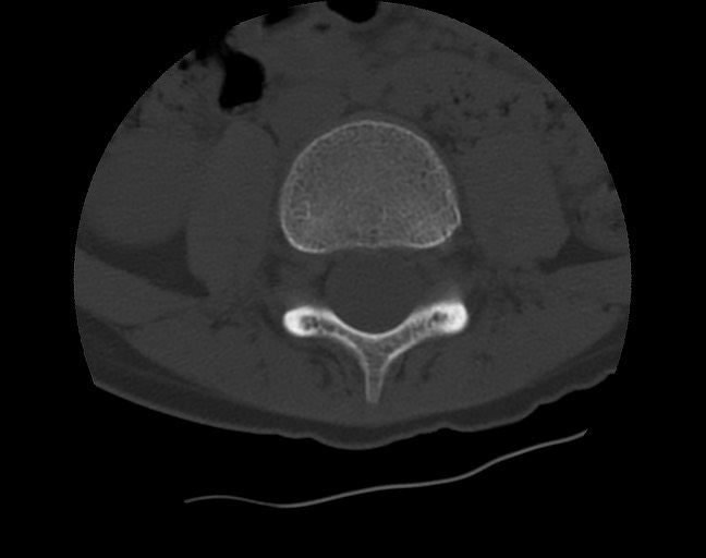 Aneurysmal bone cyst - sacrum (Radiopaedia 65190-74195 Axial bone window 2).jpg