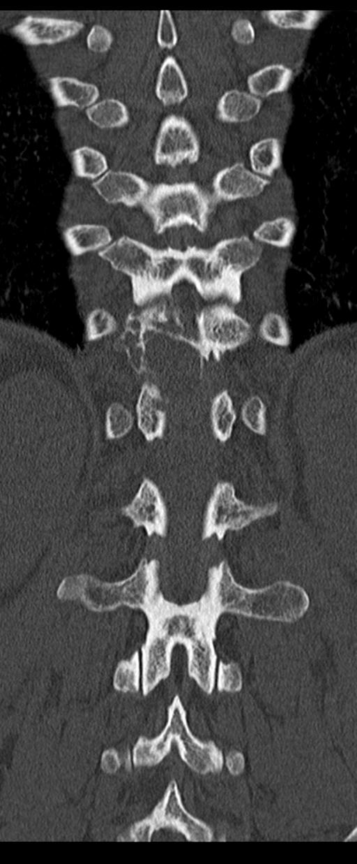 Aneurysmal bone cyst T11 (Radiopaedia 29294-29721 Coronal bone window 45).jpg
