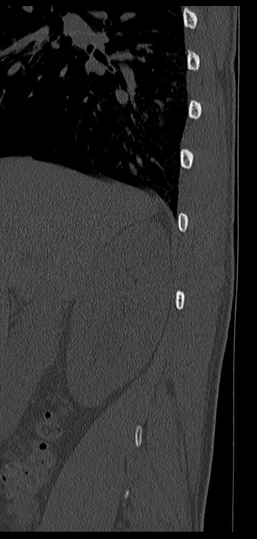Aneurysmal bone cyst T11 (Radiopaedia 29294-29721 Sagittal bone window 75).jpg