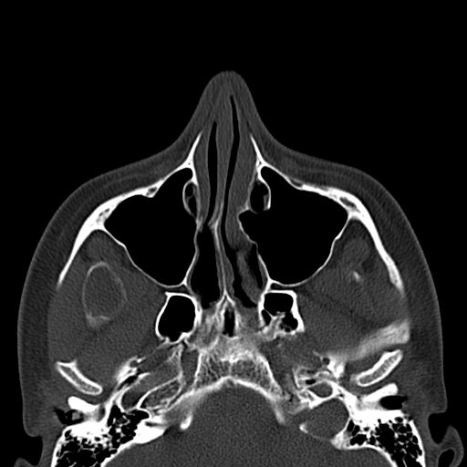 Aneurysmal bone cyst of the mandible (Radiopaedia 43280-46601 Axial bone window 74).jpg