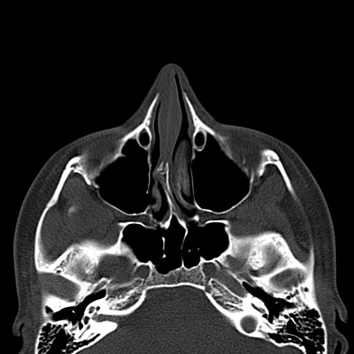Aneurysmal bone cyst of the mandible (Radiopaedia 43280-46601 Axial bone window 81).jpg