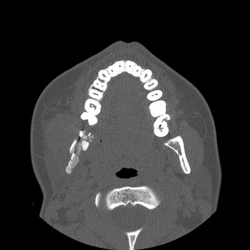 Aneurysmal bone cyst of the mandible (Radiopaedia 43280-46823 Axial bone window 74).jpg