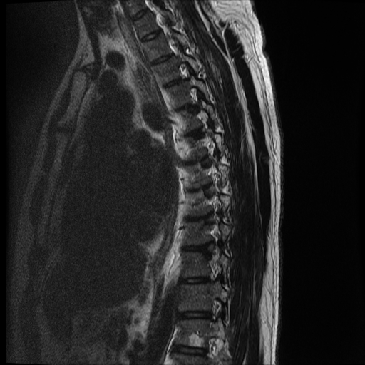 File:Angiolipoma - thoracic spine (Radiopaedia 28242-28479 Sagittal T2 4).jpg