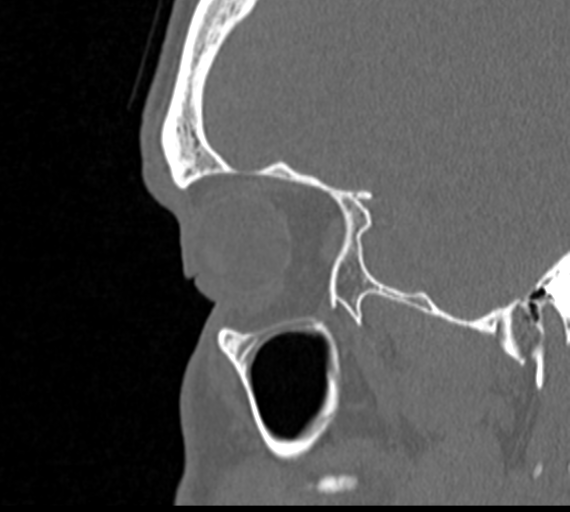 Angular epidermoid cyst (Radiopaedia 46908-51439 Sagittal bone window 12).png
