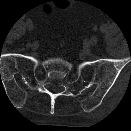 Ankylosing spondylitis complicated by fracture-dislocation (Radiopaedia 33583-34674 Axial non-contrast 165).jpg