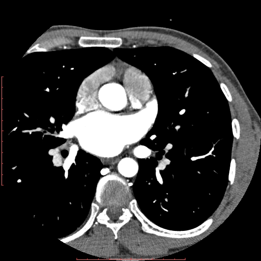 Anomalous left coronary artery from the pulmonary artery (ALCAPA) (Radiopaedia 70148-80181 A 91).jpg