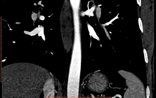 Anomalous left coronary artery from the pulmonary artery (ALCAPA) (Radiopaedia 70148-80181 B 242).jpg
