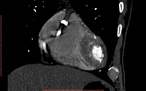 Anomalous left coronary artery from the pulmonary artery (ALCAPA) (Radiopaedia 70148-80181 B 73).jpg