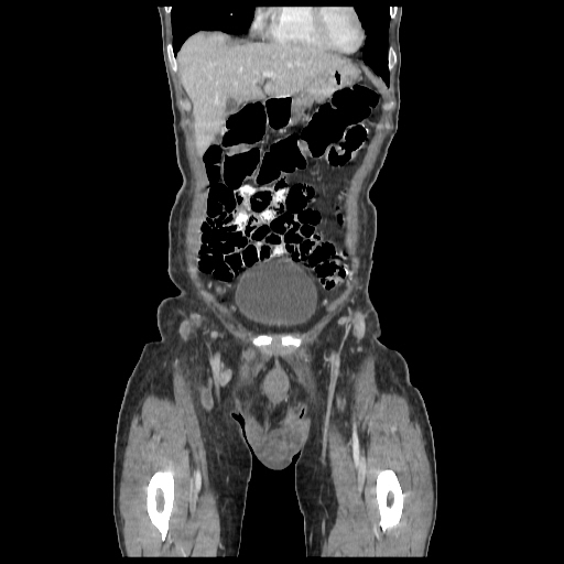 Anorectal carcinoma (Radiopaedia 44413-48064 B 6).jpg