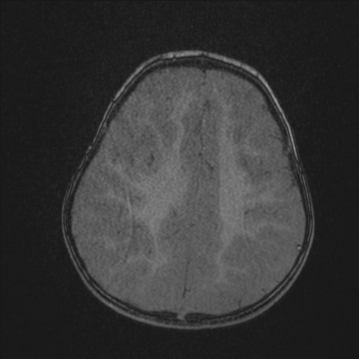 Anoxic brain injury (Radiopaedia 79165-92139 Axial MRA 188).jpg