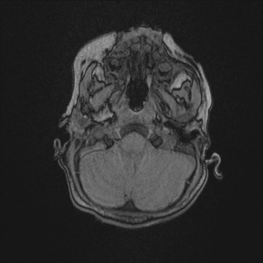 Anoxic brain injury (Radiopaedia 79165-92139 Axial MRA 35).jpg