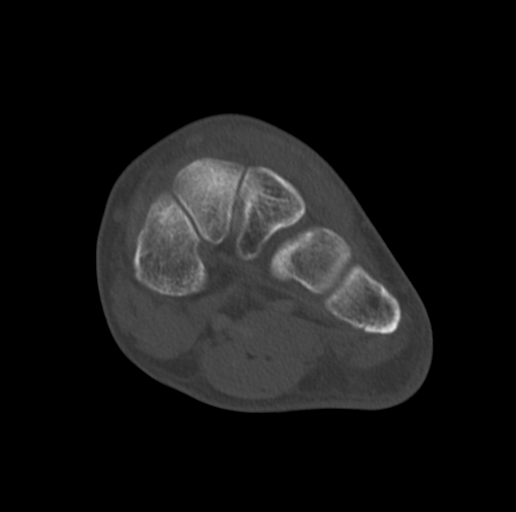 Anterior calcaneal process fracture (Radiopaedia 47384-51989 Coronal bone window 44).png