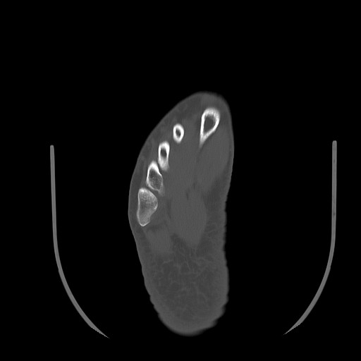 Anterior calcaneal process fracture (Radiopaedia 82590-96762 Axial bone window 35).jpg