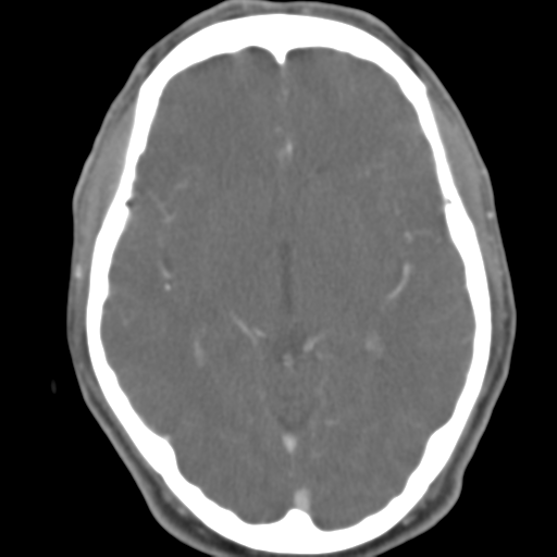 File:Anterior cerebral artery territory infarct (Radiopaedia 39327-41581 B 32).png