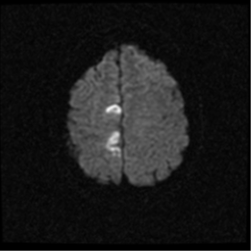 File:Anterior cerebral artery territory infarct (Radiopaedia 39327-41584 Axial DWI 21).png
