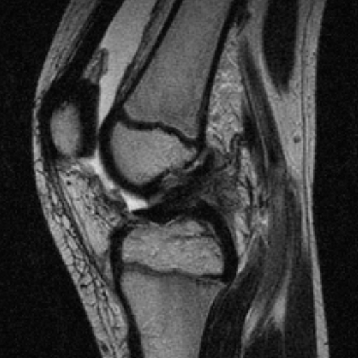 File:Anterior cruciate ligament avulsion fracture (Radiopaedia 24710-24974 Sagittal T2 7).jpg