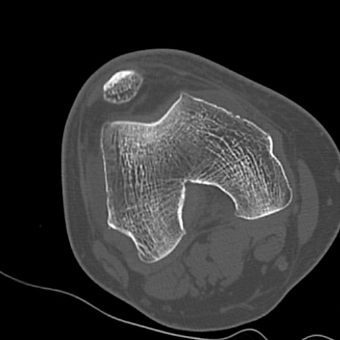 File:Anterior cruciate ligament avulsion fracture (Radiopaedia 58939-66194 Axial bone window 5).jpg