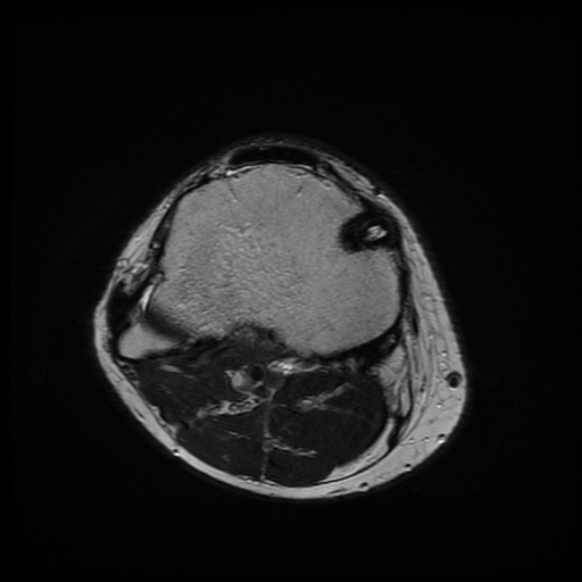 File:Anterior cruciate ligament graft tear and bucket-handle tear of medial meniscus (Radiopaedia 75867-87254 Axial T2 4).jpg