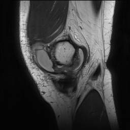 Anterior cruciate ligament rupture with Segond fracture (Radiopaedia 69043-78806 Sagittal PD 34).jpg
