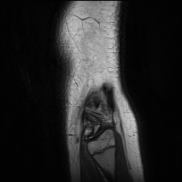 Anterior cruciate ligament tear - pediatric (Radiopaedia 62152-70260 Sagittal PD 161).jpg
