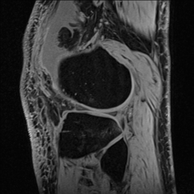 Anterior cruciate ligament tear - ramp lesion (Radiopaedia 71883-82322 Sagittal T1 vibe 35).jpg