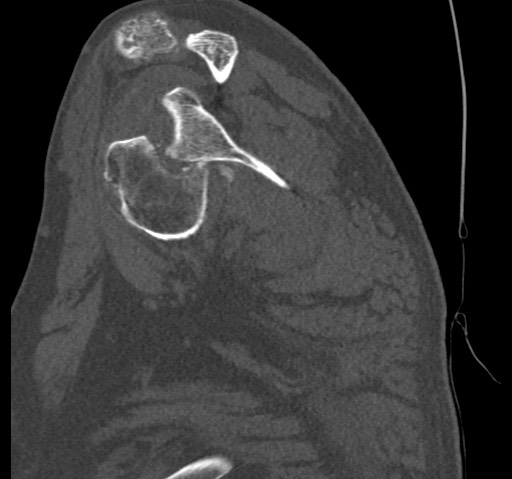 Anterior glenohumeral dislocation with Hill-Sachs lesion (Radiopaedia 62877-71249 Sagittal bone window 31).jpg