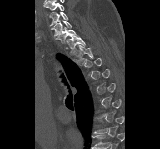 Anterior glenohumeral dislocation with Hill-Sachs lesion (Radiopaedia 62877-71249 Sagittal bone window 79).jpg