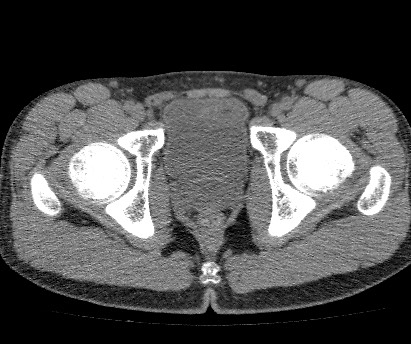 Anterior inferior iliac spine avulsion fracture (Radiopaedia 81312-94999 Axial non-contrast 57).jpg