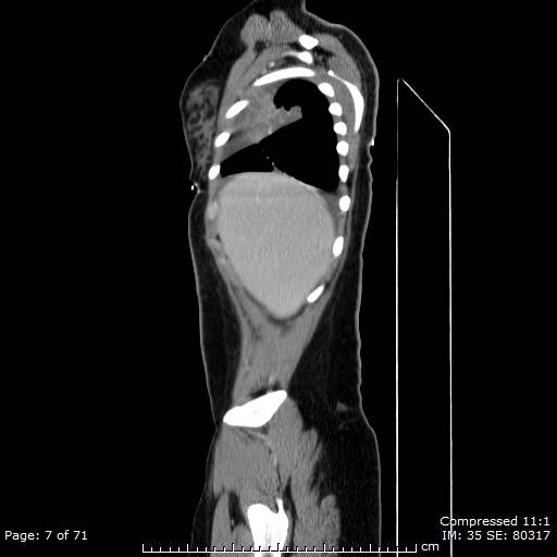 File:Anterior mediastinal B cell Lymphoma (Radiopaedia 50677-56114 C 4).jpg