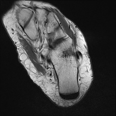 File:Anterior talofibular ligament injury - rupture with soft-tissue impingement (Radiopaedia 38765-40928 Axial PD 27).jpg