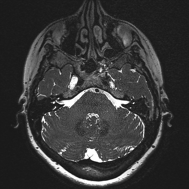 Anterior temporal encephalocele (Radiopaedia 82624-96808 Axial T2 high res 20).jpg