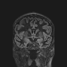 Anterior temporal encephalocele (Radiopaedia 82624-96808 Coronal FLAIR 21).jpg