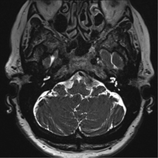 Anterior temporal pole cysts (Radiopaedia 46629-51102 Axial T2 24).png