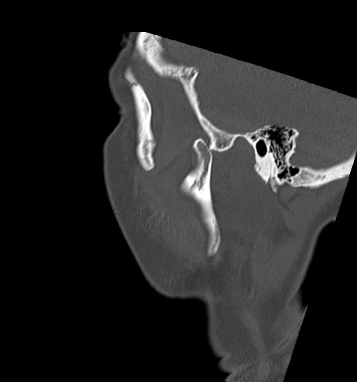 File:Anterior temporomandibular joint dislocation (Radiopaedia 59430-66784 B 56).jpg