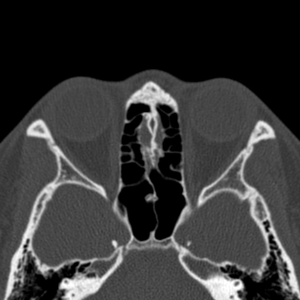 Antrochoanal polyp (Radiopaedia 33984-35202 Axial bone window 53).jpg