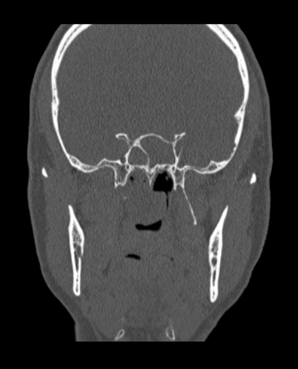 Antrochoanal polyp (Radiopaedia 79011-92169 Coronal bone window 22).jpg