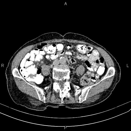 Aortic aneurysm and Lemmel syndrome (Radiopaedia 86499-102554 Axial C+ delayed 50).jpg