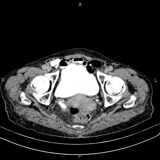 Aortic aneurysm and Lemmel syndrome (Radiopaedia 86499-102554 Axial C+ delayed 73).jpg