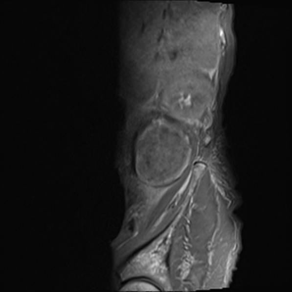 File:Aortic aneurysm with spinal destruction (Radiopaedia 42301-45409 Sagittal T1 fat sat 6).jpg