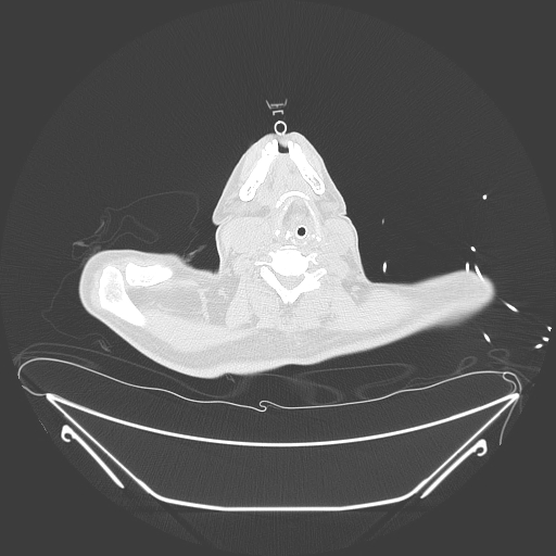 Aortic arch aneurysm (Radiopaedia 84109-99365 Axial lung window 5).jpg