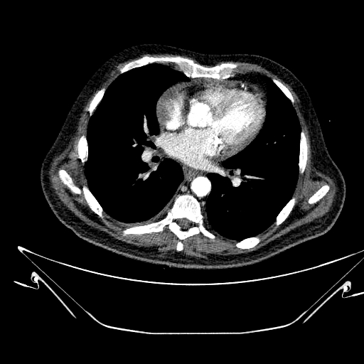 Aortic arch aneurysm (Radiopaedia 84109-99365 B 352).jpg