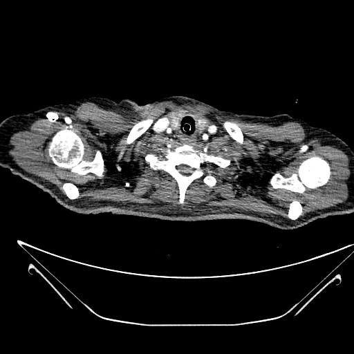 Aortic arch aneurysm (Radiopaedia 84109-99365 B 37).jpg