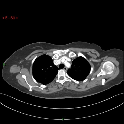Aortic arch origin of left vertebral artery (Radiopaedia 51520-57286 A 59).jpg