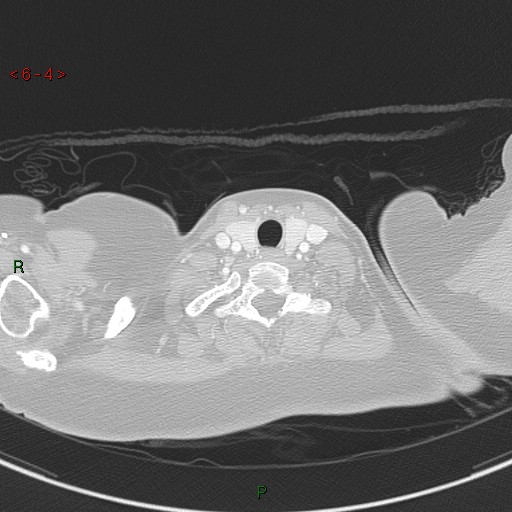 Aortic arch origin of left vertebral artery (Radiopaedia 51520-57286 Axial lung window 4).jpg